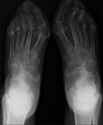 Joint deformities of the feet secondary to inflammatory joint disease