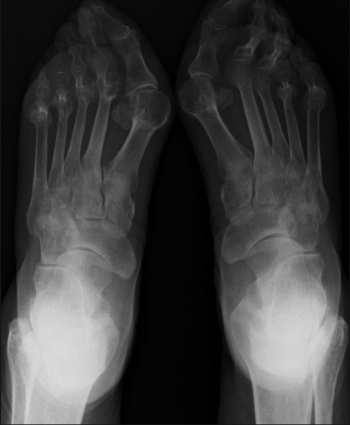 Joint deformities of the feet secondary to inflammatory joint disease