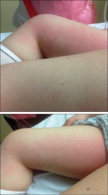 Figures 1 and 2. The rash, which had previously been more extensive, became more localised to the groin streaking upwards medially to the inguinal region bilaterally and had a sunburn like appearance