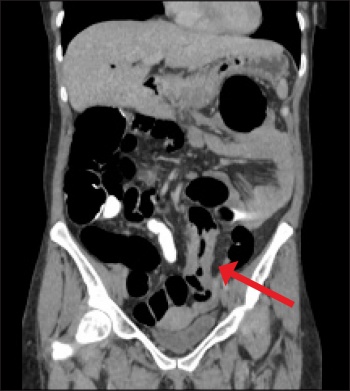 Figure 1. CT colonography (coronal reformat) demonstrating circumferential mural thickening of the sigmoid colon consistent with a sigmoid malignancy