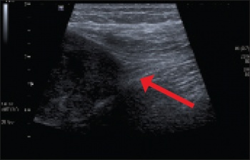 Figure 2. Ultrasound of solid mass in the posterior aspect of the thigh in continuity with the sciatic nerve, consistent with a peripheral nerve sheath tumour (PNST) 