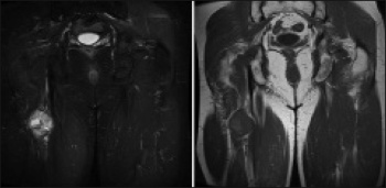 Figure 3. Corresponding coronal T1 and T2 weighted MRI confirmed ultrasound findings of a PNST of the sciatic nerve. Patient had subsequent staging CT of thorax, abdomen and pelvis
