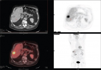 Figure 4. PET-CT demonstrating avid tracer uptake in a solitary hepatic lesion consistent with a malignancy