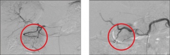 Figure 5. Selected images during a trans-arterial embolisation of hepatic metastases. Neovascularity demonstrated from a proximal branch of the right hepatic artery corresponding to a metastatic deposit. Selective coil embolisation performed with post-procedure angiogram demonstrating cessation of blood supply to the tumour