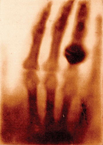 Detail from the first-ever medical x-ray, the hand of Mrs Wilhelm Röntgen, 1895