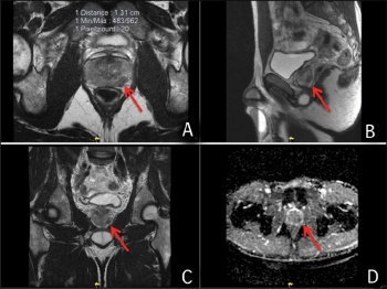 Figure 1. Image A, B and C demonstrate a lesion in the left apex of the prostate with diffusion anomalies present in image D