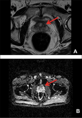 Figure 2. MRI images demonstrate a lesion on the anterior surface of the prostate in image A, with diffusion abnormalities in image B