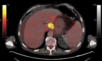 Figure 1. Oesophageal carcinoma.
