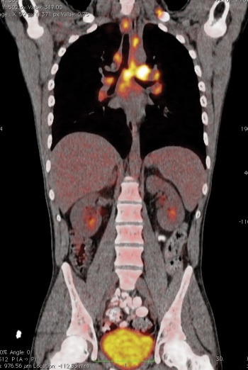 Figure 3. Body scan showing lymphoma