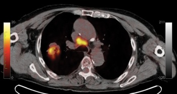 Figure 4. Scan of patient’s lung