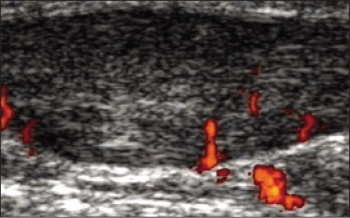 Figure 1. Longitudinal colour Doppler ultrasound of the Achilles tendon showing both hypoechoic regions and areas of neovascularisation