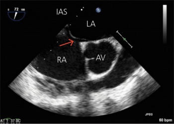 Figure 1. Tunnel PFO visible between RA and LA (red arrow)