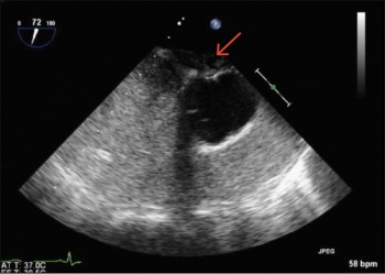 Figure 2. Positive bubble study, with opacification of RA and RV, showing flow of contrast from RA into LA directly across PFO in IAS (indicated by arrow)