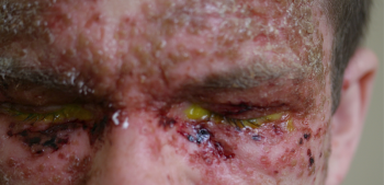 Figure 1: eczema herpeticum on face