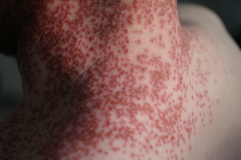 Figure 2: eczema herpeticum on neck