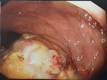 Figure 1. Colonic metastases from malignant melanoma