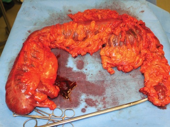 Figure 2. Right haemicolectomy