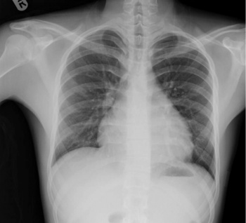 Figure 1: Chest x-ray showing globular cardiac silhouette