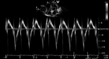 Figure 2: Tissue Doppler tracing high velocity myocardial excursions E’ @18 demonstrating pericardial constriction. Tissue Doppler is valuable in distinguishing constrictive from restrictive pericarditis showing high velocity excursions in the former and lower velocities in the latter; a cut off of 8 has been recommended by some authors
