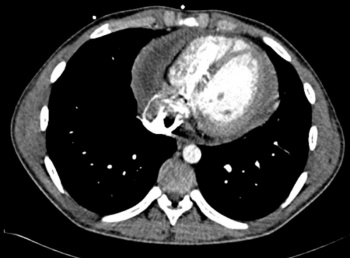 Figure 3: CT thorax showing a large pericardial effusion