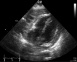 Figure 4: Subcostal view showing a thick exudative pericardial effusion. Thick fibrinous strands can be seen crossing the space and tethering the myocardium to the pericardium