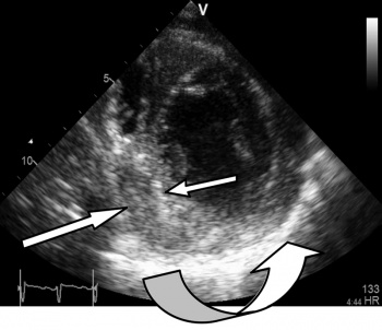 Figure 5: Short axis view showing a thickened hyper-echoic pericardium especially between 4 and 7 o’clock (curved arrow). Organised thick effusion indenting the infero-septal left ventricular wall between 6 and 9 o’clock (straight arrows)