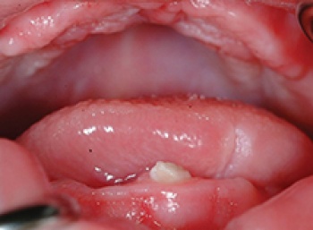 Figure 1. Natal tooth in two-day old infant