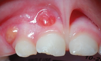Figure 2. Trauma to primary teeth with infection