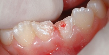 Figure 3. Trauma to permanent teeth