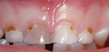 Figure 6. Anterior caries with infection