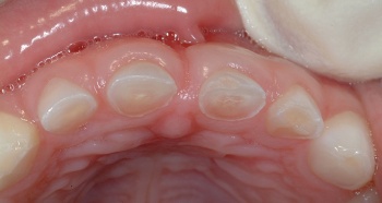 Figure 8. Erosion of anterior teeth due to drinking juice