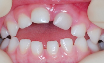 Figure 9. Anterior open bite due to prolonged pacifier sucking