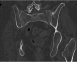 Figure 2a. Coronal pelvic CT of 68-year-old female with chronic ‘low back pain’ demonstrating bilateral sacral insufficiency fractures