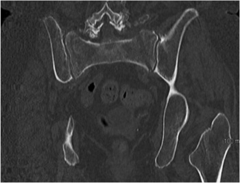 Figure 2a. Coronal pelvic CT of 68-year-old female with chronic ‘low back pain’ demonstrating bilateral sacral insufficiency fractures