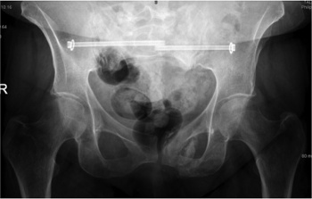 Figure 2b. Plain film pelvic x-ray six months post percutaneous fixation of bilateral sacral insufficiency fractures