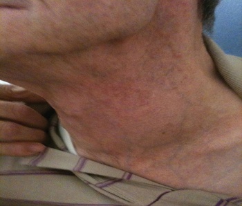 Figure 1: Swelling in the left lower neck