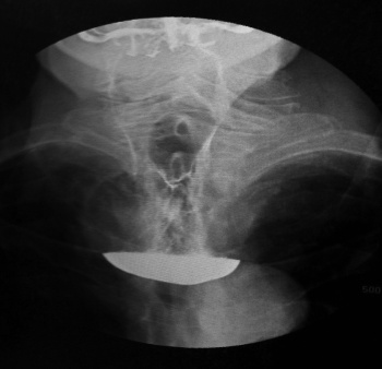 Figure 2: Barium study showing large pharyngeal pouch
