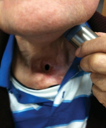 Figure 3: Patient using vibrator for speech