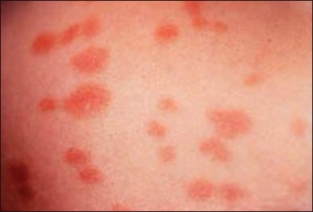 Figure 1. Cutaneous mastocytosis furticaria pigmentosal