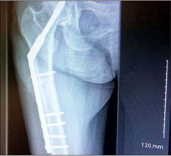 Figure 3. Conversion to eight-hole long DHS plate