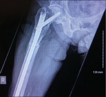 Figure 6. Cephalomedullary nailing