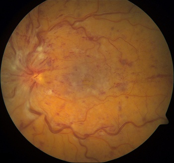 Figure 2. Left central retinal vein occlusion, showing dilated tortuous veins, optic disc oedema, retinal haemorrhages and cotton wool spots in all retinal quadrants 