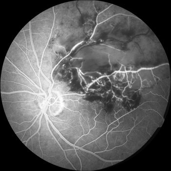 Figure 3. Fundus fluorescein angiogram of Figure 1, showing significant supero-temporal retinal ischaemia secondary to BRVO