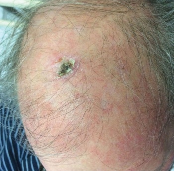 Figure 1. Rapidly growing scalp SCC in a RTR one year post-transplant, the patient had a small area of keratosis prior to his transplant that had rapidly developed on immunosuppression. He required a skin graft at excision