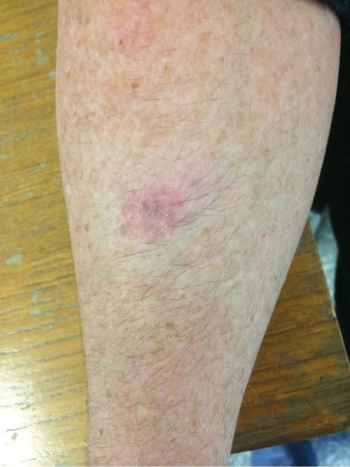 Figure 2. Bowen's (SCC in situ) on the lower limb, required excision and skin grafting