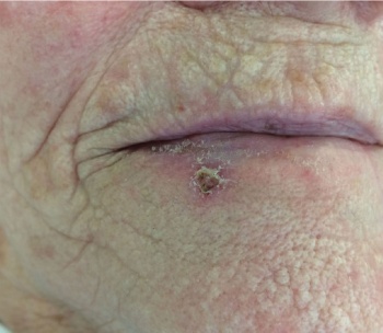 Figure 3. Lower lip SCC. The patient had a previous wedge excision of an SCC of the lower left lip