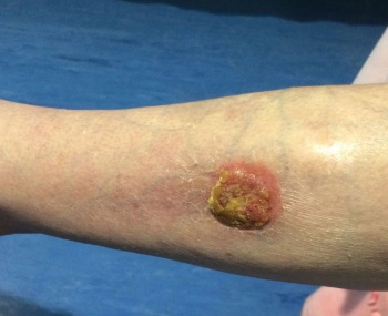 Figure 4. Large SCC on the lower limb, required excision and skin grafting. The patient was placed on post-operative antibiotics as it was ulcerating. The patient had no inguinal lymphadenopathy on examination