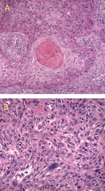 Figure 5. High power magnification of a well differentiated SCC (A) and a poorly differentiated SCC (B) 