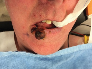 Figure 6. Large lip SCC required complex reconstruction with an advancement rotation flap