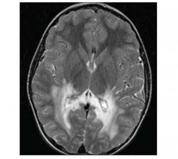 Figure 1. Axial T-weighted image showing bilateral extensive white matter lesion in the occipital lobe